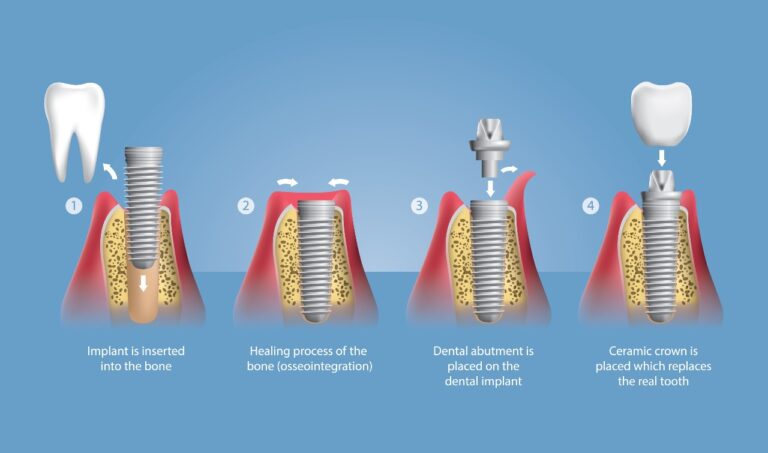 How dental implants works