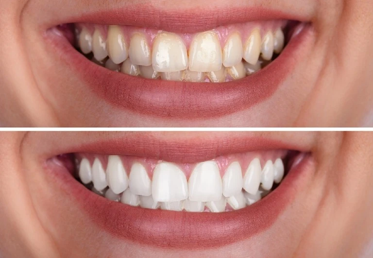 Affordable Teeth Whitening illustration