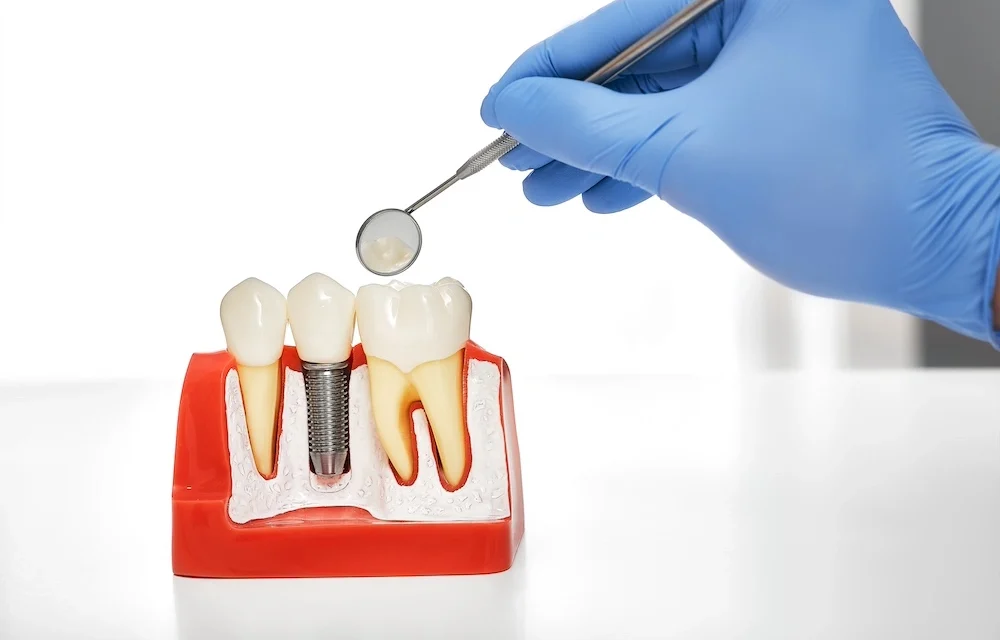 Long-Term Care Tips to Extend Your Dental Implant’s Lifespan