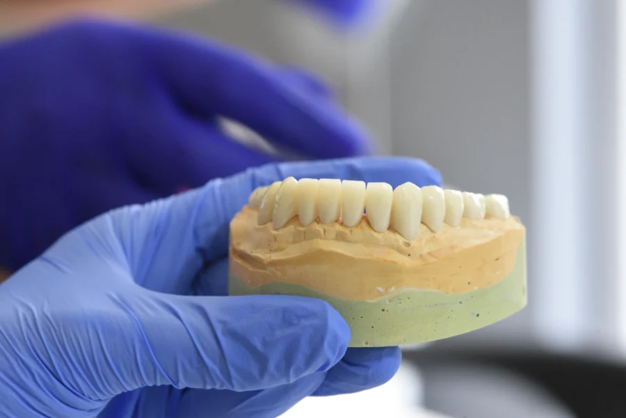 How Long Do Dental Implants Last? What Patients Should Know About Dental Implant Lifespan